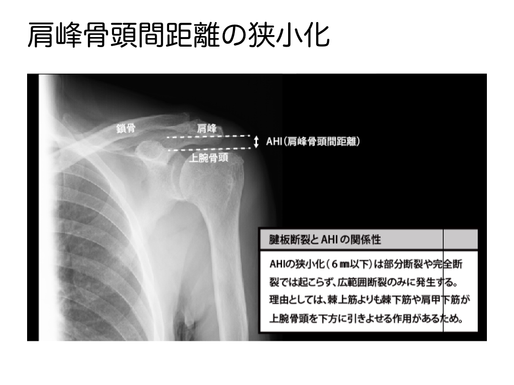 2 肩峰下インピンジメント 腱板損傷