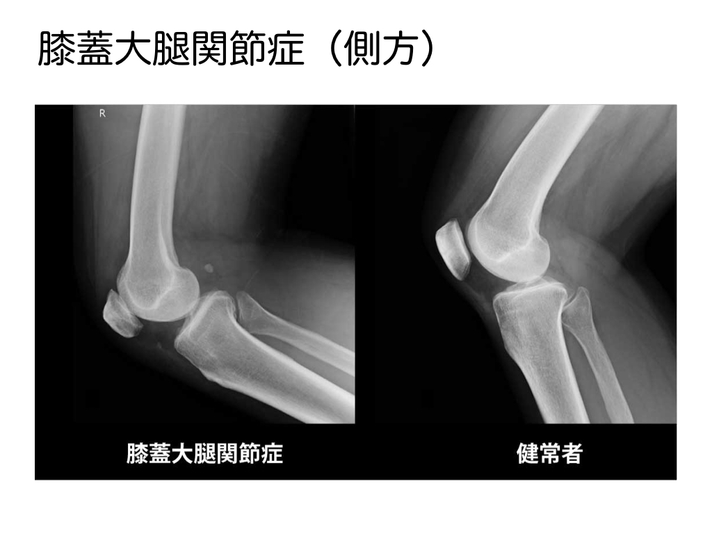 2 膝蓋大腿関節症 膝蓋下脂肪体