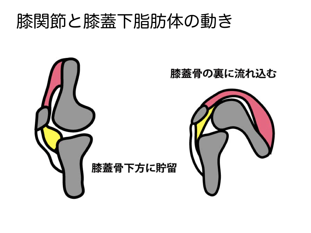2 膝蓋大腿関節症 膝蓋下脂肪体 2 膝蓋大腿関節症 膝蓋下脂肪体